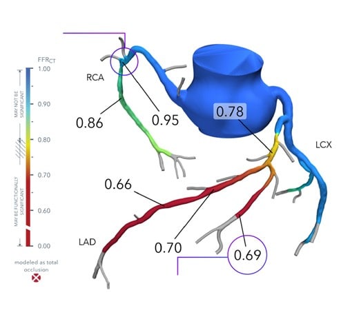 A color-coded 3D model of coronary arteries generated by Heartflow’s AI, with annotated fractional flow reserve values at different artery segments, visually indicating areas of normal and reduced blood flow to help assess the functional significance of coronary blockages.